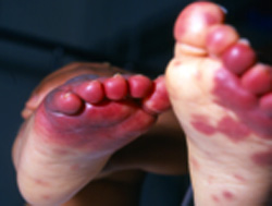 edema_hemorragico_agudo/lesiones_eritematosas_violaceas_EHAI edema_hemorragico_agudo/lesiones_eritematosas_violaceas_EHAI