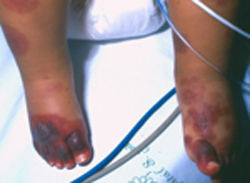 edema_hemorragico_agudo/lesiones_predominio_extremidades edema_hemorragico_agudo/lesiones_predominio_extremidades