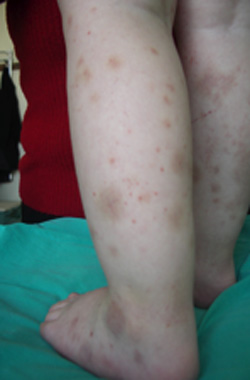 edema_hemorragico_agudo/mejoria_progresiva_lesiones edema_hemorragico_agudo/mejoria_progresiva_lesiones