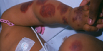 edema_hemorragico_agudo/sufusiones_hemorragicas_confluentes edema_hemorragico_agudo/sufusiones_hemorragicas_confluentes