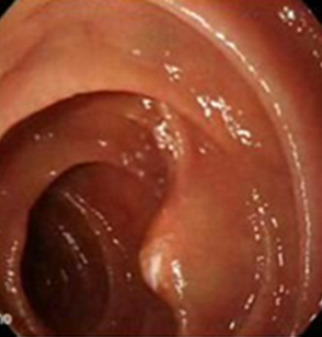 endoscopia_linfangiectasia_intestinal/disminuido_salida_linfa endoscopia_linfangiectasia_intestinal/disminuido_salida_linfa