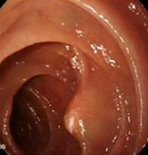 endoscopia_linfangiectasia_intestinal/disminuido_salida_linfa