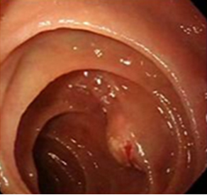 endoscopia_linfangiectasia_intestinal/lesion_disminuido_biopsia