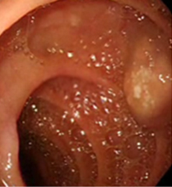 endoscopia_linfangiectasia_intestinal/lesion_nodular_blanquecina