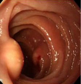 endoscopia_linfangiectasia_intestinal/lesiones_linfangiectasia_duodenal endoscopia_linfangiectasia_intestinal/lesiones_linfangiectasia_duodenal