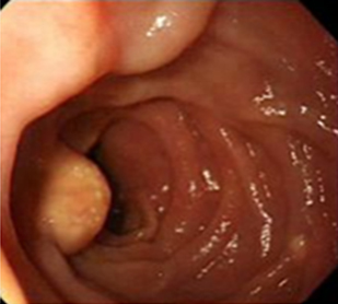 endoscopia_linfangiectasia_intestinal/linfangiectasia_cara_anterior endoscopia_linfangiectasia_intestinal/linfangiectasia_cara_anterior