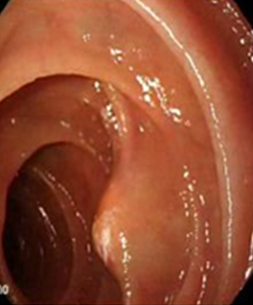 endoscopia_linfangiectasia_intestinal/linfangiectasia_posterior_biopsia endoscopia_linfangiectasia_intestinal/linfangiectasia_posterior_biopsia
