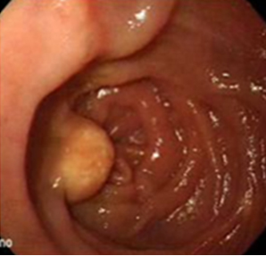 endoscopia_linfangiectasia_intestinal/manchas_superficie_nodular
