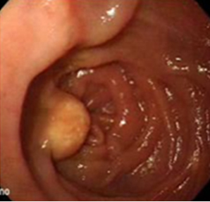 endoscopia_linfangiectasia_intestinal/manchas_superficie_nodular endoscopia_linfangiectasia_intestinal/manchas_superficie_nodular