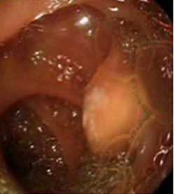 endoscopia_linfangiectasia_intestinal/nodulo_cara_posterior