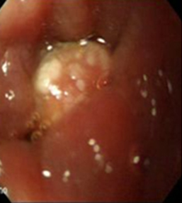 endoscopia_linfangiectasia_intestinal/primera_lesion_nodural