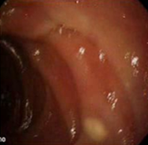 endoscopia_linfangiectasia_intestinal/ultima_reducido_diametro