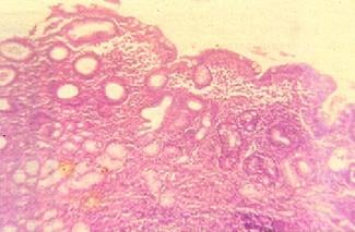 histologia_Helicobacter_pylori/Gastritis_atrofica_metaplasia