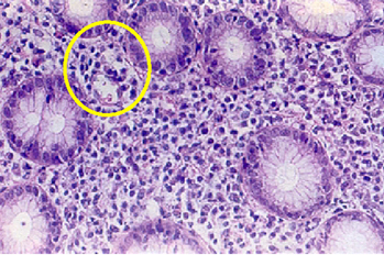 histologia_Helicobacter_pylori/Gastritis_micro_absceso