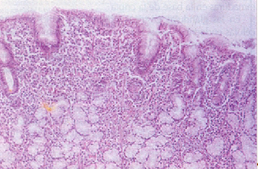 histologia_Helicobacter_pylori/Grastritis_cronica_antral