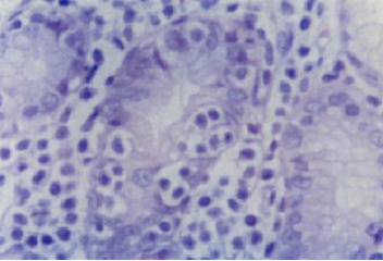 histologia_Helicobacter_pylori/Lesion_linfoepitelial_tipica