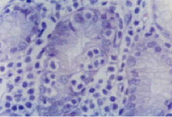 histologia_Helicobacter_pylori/Lesion_linfoepitelial_tipica histologia_Helicobacter_pylori/Lesion_linfoepitelial_tipica