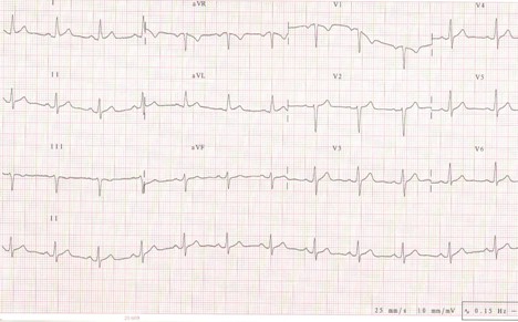 manejo_dolor_toracico/ECG_electrocardiograma_miocarditis manejo_dolor_toracico/ECG_electrocardiograma_miocarditis