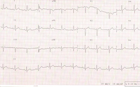 manejo_dolor_toracico/ECG_electrocardiograma_miocarditis