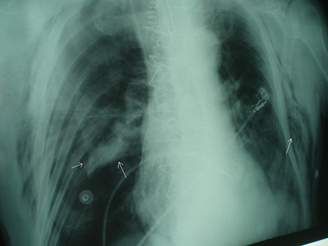 neumotorax_hipertensivo_bilateral/radiografia_RX_AP