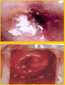 papiloma_virus_humano/lesiones_cuello_uterino