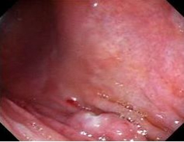 polipos_estomago_duodeno/base_implantacion_polipo polipos_estomago_duodeno/base_implantacion_polipo