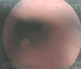 polipos_estomago_duodeno/polipo_esogagico_sesil polipos_estomago_duodeno/polipo_esogagico_sesil