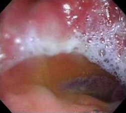 polipos_estomago_duodeno/polipo_gastrico_pediculado polipos_estomago_duodeno/polipo_gastrico_pediculado
