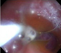 polipos_estomago_duodeno/polipo_gastrico_polipectomia polipos_estomago_duodeno/polipo_gastrico_polipectomia