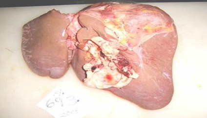 tumor_Krukenberg_cancer/tumor_vesicula_biliar