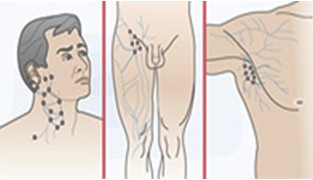 adenopatias_atencion_primaria/ganglios_abdominales_cervicales