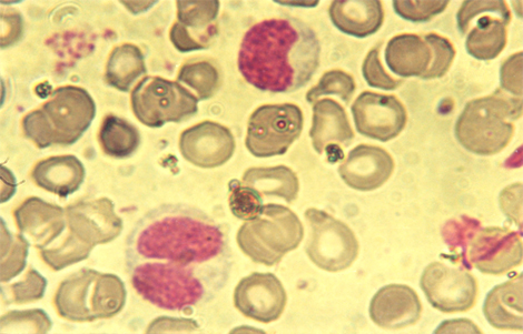 choque_directo_radioactivo/leucemia_metamielocito_paraneutrofilo