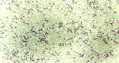 choque_directo_radioactivo/leucemia_mieloide_cronica