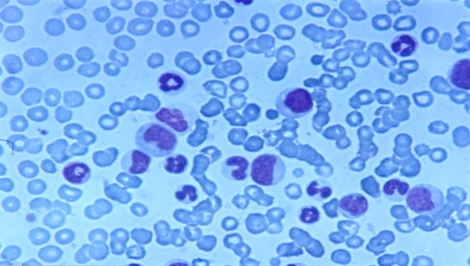 choque_directo_radioactivo/leucemia_mieloide_cronica2