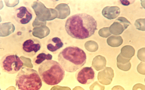 choque_directo_radioactivo/leucemia_mieloide_cronica3