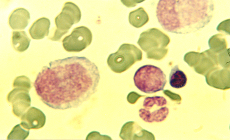 choque_directo_radioactivo/leucemia_mieloide_cronica4