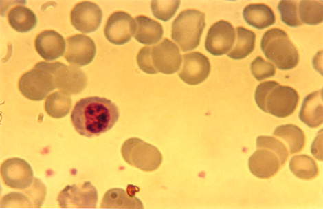 choque_directo_radioactivo/neutrofilo_irradiado_unilobular