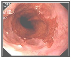 diagnostico_esofago_Barret/endoscopia_videoendoscopia_gastroscopia
