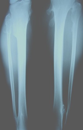 encondromatosis_multiple_Ollier/caso_clinico_radiografia