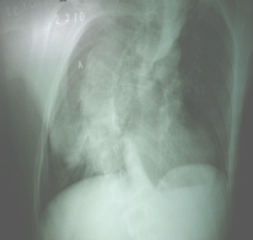 escoliosis_dorsal_congenita/desviacion_columna_vertebral