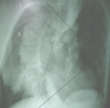 escoliosis_dorsal_congenita/radioopacidad_hemitorax_derecho