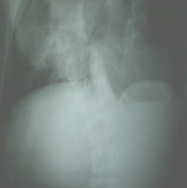 escoliosis_dorsal_congenita/separacion_cuerpos_vertebrales