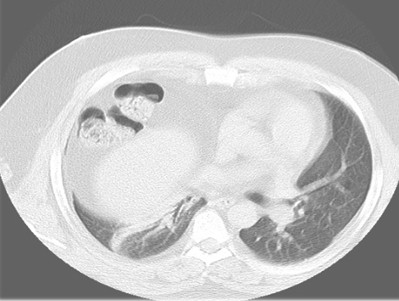 eventracion_diafragmatica_caso/clinico_TAC_pulmonar