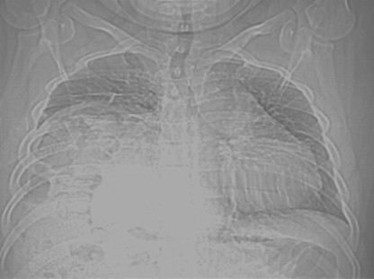 eventracion_diafragmatica_caso/clinico_radiografia_atelectasia