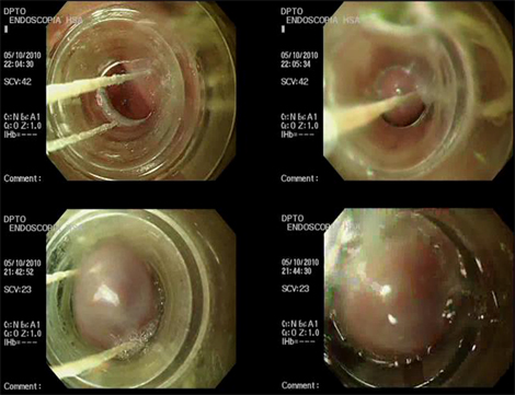 ligadura_varices_esofagicas/varices_esofagicas_2