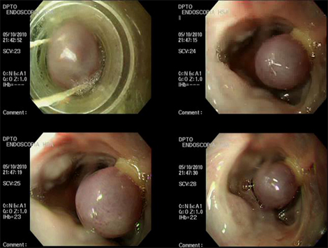 ligadura_varices_esofagicas/varices_esofagicas_3