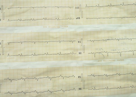 mixoma_auricular_gigante/ECG_onda_P_gigante mixoma_auricular_gigante/ECG_onda_P_gigante
