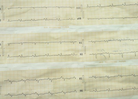 mixoma_auricular_gigante/ECG_onda_P_gigante