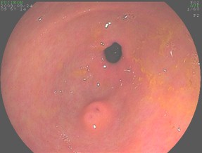 pancreas_aberrante_caso/clinico_heterotopia_pancreatica