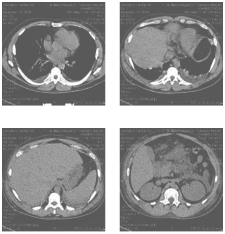 pancreatitis_aguda_edematosa/TAC_abdominal_pancreas